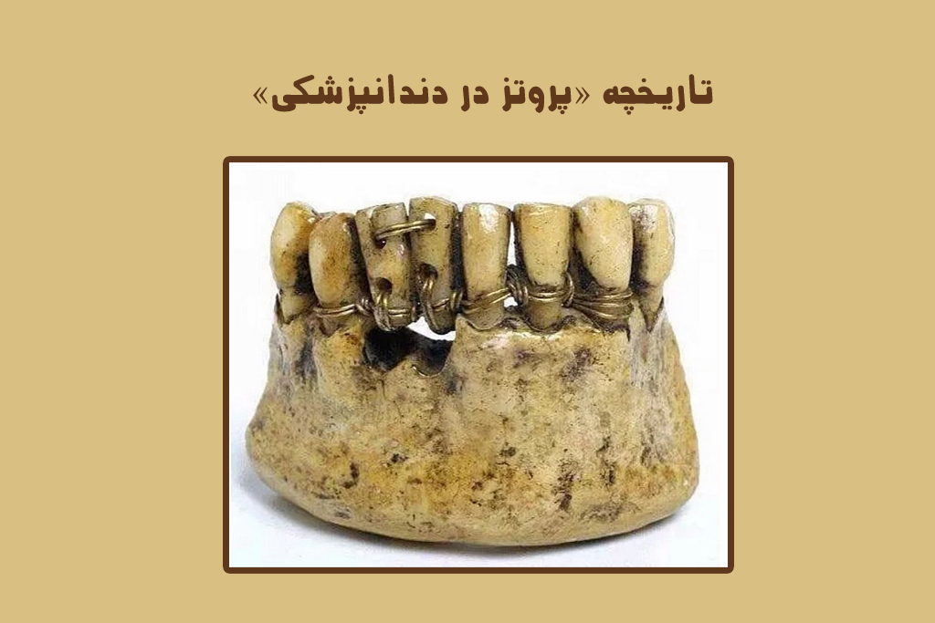 روایتی طنز از تاریخچه پروتز در دندانپزشکی